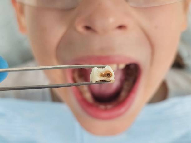 Best Emergency Treatment for Dental Infections or Abscesses in Advae, NC