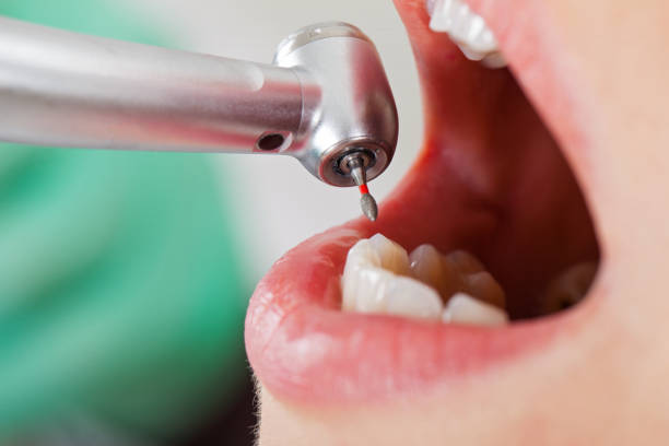 Best Emergency Gum Treatment in Advae, NC